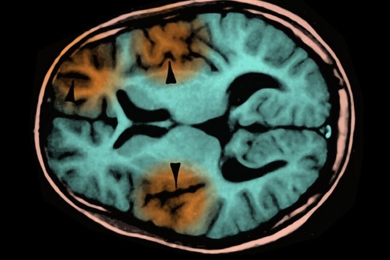 Measles Death Shows How Virus Can Hide in the Brain for Years